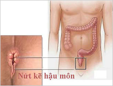 Ảnh bệnh hậu môn - 4
