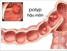 Ảnh bệnh hậu môn - 6