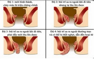 Dấu hiệu bệnh trĩ giai đoạn đầu