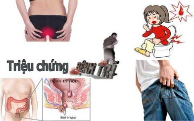Triệu chứng bị trĩ không nên coi thường