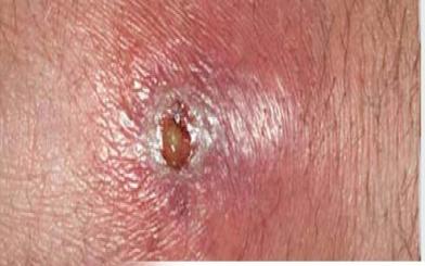 Nổi hột ở hậu môn là bệnh gì?