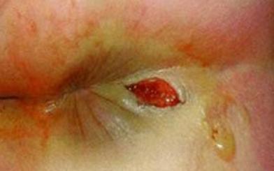 Trẻ sơ sinh bị loét hậu môn nguyên nhân do đâu?