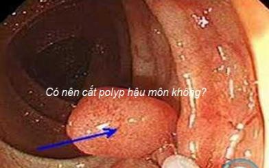Có nên cắt polyp hậu môn không?