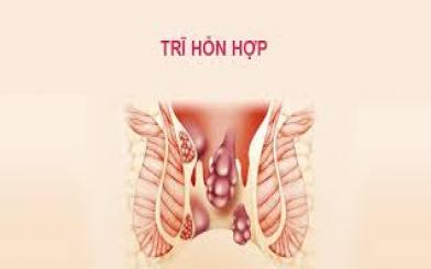 Bệnh trĩ hỗn hợp là gì?