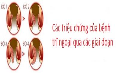 Các triệu chứng trĩ ngoại thường gặp