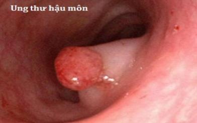 Cảnh báo biến chứng khi bị khó đi đại tiện