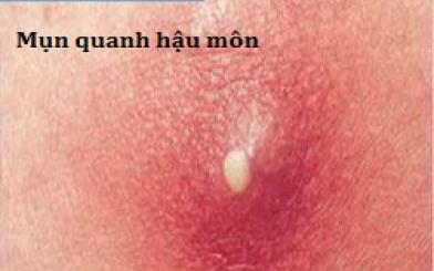 Bạn đã biết dấu hiệu rò hậu môn ở nam giới