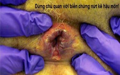 Đừng chủ quan với biến chứng nứt kẽ hậu môn