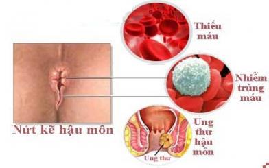 Những biến chứng nứt kẽ hậu môn bạn cần biết