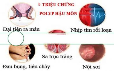 5 triệu chứng polyp hậu môn bạn không nên bỏ qua