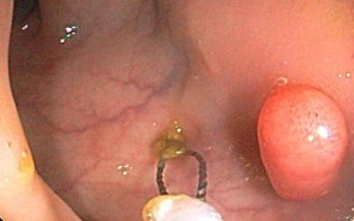 Tìm hiểu về bệnh polyp hậu môn