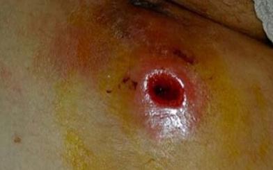 Áp xe hậu môn ở trẻ nhỏ như thế nào?