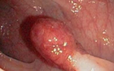 Chớ coi thường những dấu hiệu polyp hậu môn