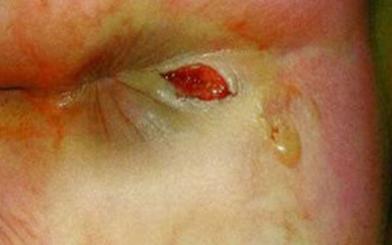 Một số tác hại rò hậu môn và cách chữa trị hiệu quả