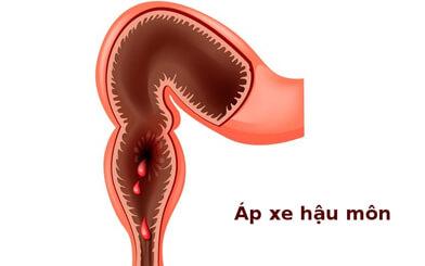 Bệnh nứt kẽ hậu môn có tự khỏi không?