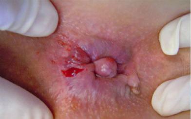 Bật mí những nguy hiểm khi bị nứt kẽ hậu môn sau sinh