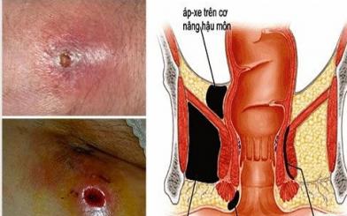 Những hình ảnh apxe hậu môn thực tế khi nhiễm bệnh