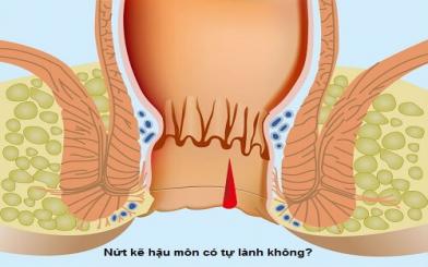 Nứt kẽ hậu môn có tự lành không?