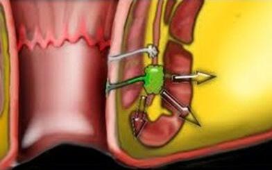 Chớ coi thường các dấu hiệu tái phát rò hậu môn