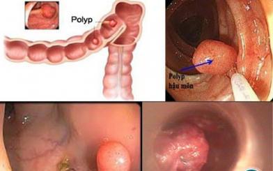Tiết lộ cho bạn một số hình ảnh polyp hậu môn