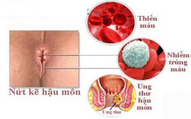 Nứt kẽ hậu môn bao lâu thì khỏi