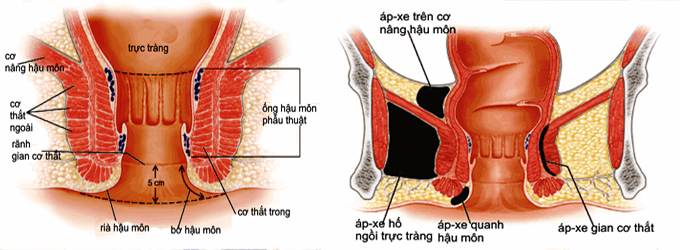 5 nguyên nhân gây apxe hậu môn