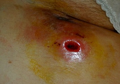 dấu hiệu bệnh apxe hậu môn