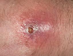 Apxe hậu môn là gì