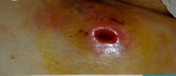 cách phòng tránh apxe hậu môn