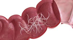 Bé bị nhiễm giun kim