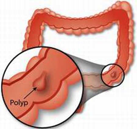 Bí kíp phòng tránh polyp hậu môn