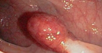 những dấu hiệu polyp hậu môn chớ coi thường