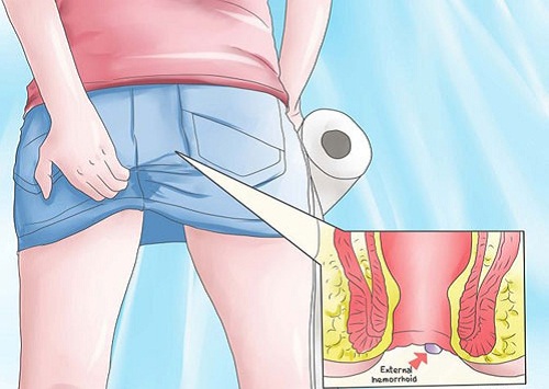 Mẹo chứa ngứa hậu môn