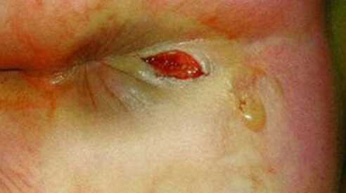 tác hại rò hậu môn