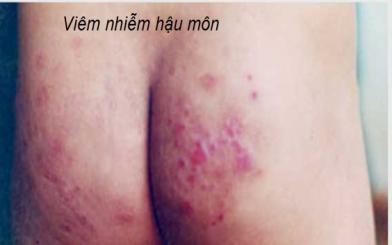 Gây viêm nhiễm hậu môn