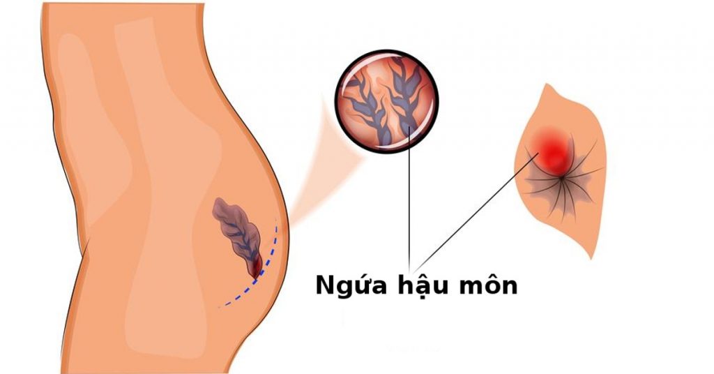 Nguyên nhân gây ngứa rát hậu môn