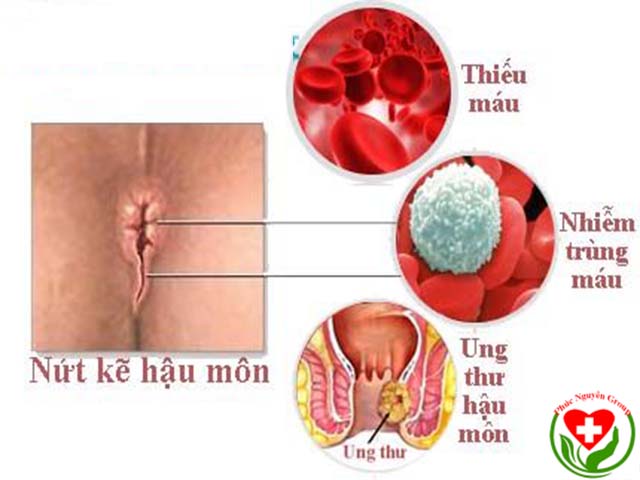 Nứt kẽ hậu môn bao lâu thì khỏi