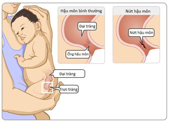 nứt kẽ hậu môn ở trẻ em