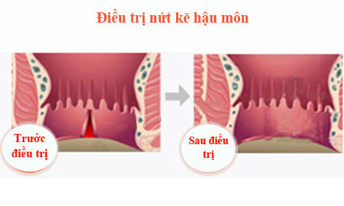 Nứt kẽ hậu môn và cách điều trị
