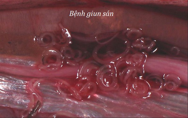 Bệnh giun sán