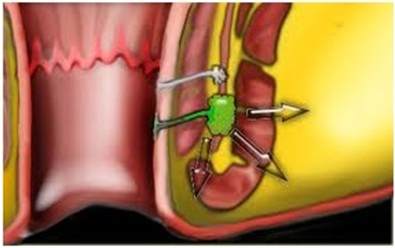 Rò hậu môn sau phẫu thuât